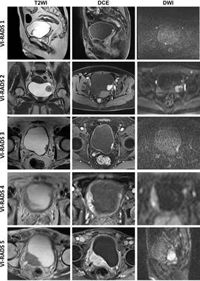 Combining Multiparametric MRI Radiomics Signature With the Vesical Imaging-Reporting and Data System (VI-RADS) Score to Preoperatively Differentiate Muscle Invasion of Bladder Cancer